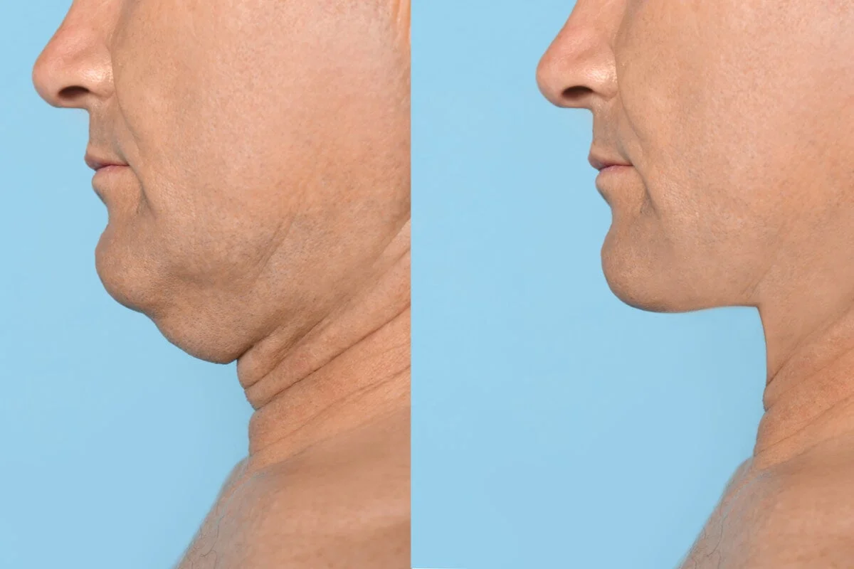 Ejercitador de mandíbula, ejercitador de línea de mandíbula, Ejercicio de Cara y Cuello para Hombres y Mujeres, Cuello Muscular Natural Delgado y Tono (Rojo) 3 ejercitador de mandibula ejercitador de linea de mandibula ejercicio de cara y cuello para hombres y mujeres cuello muscular natural delgado y tono rojo